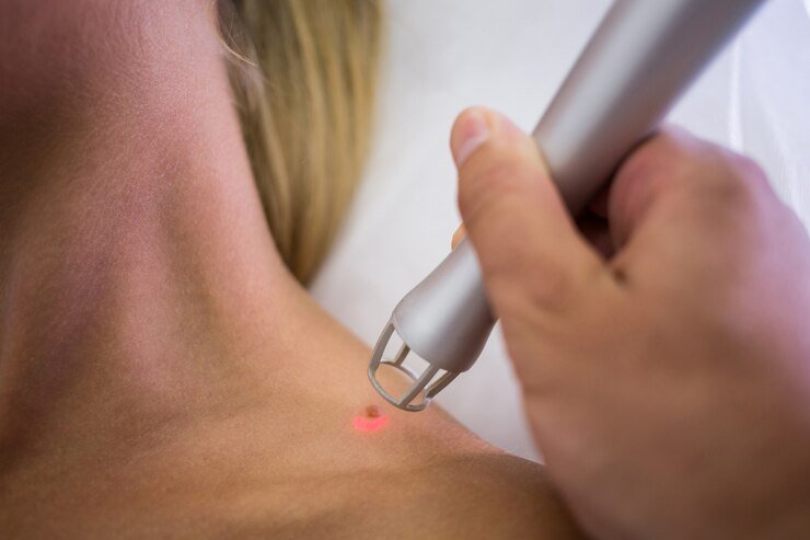 Acrochordons (Skin Tags)